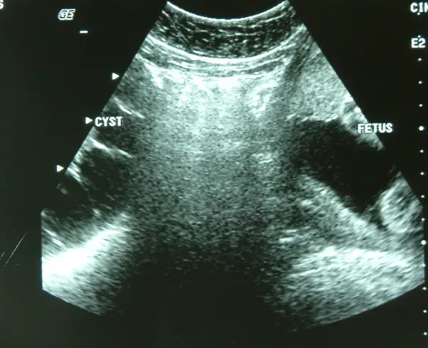 Cyst formation in ovaries